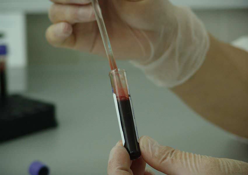 Prostata – test PSA